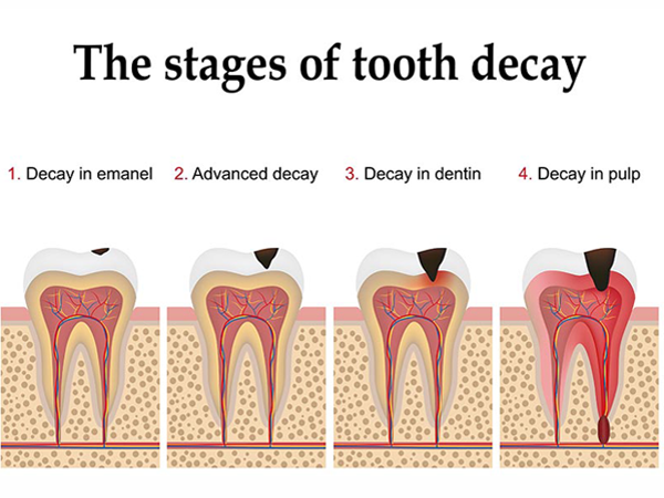 dental-dececy