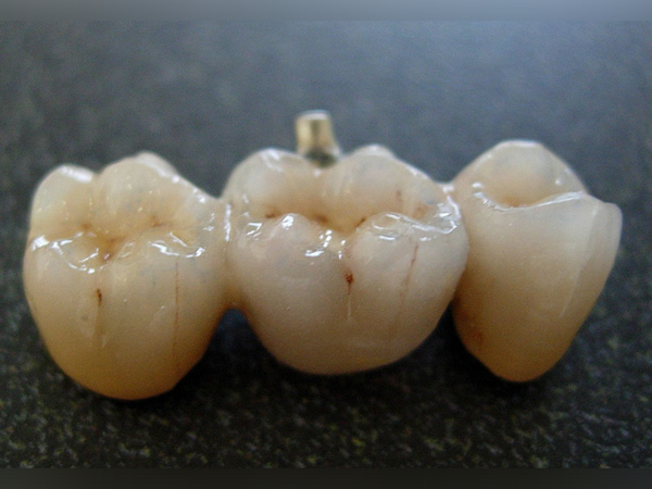 removable-denture