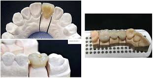 removable-denture