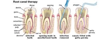 root canel